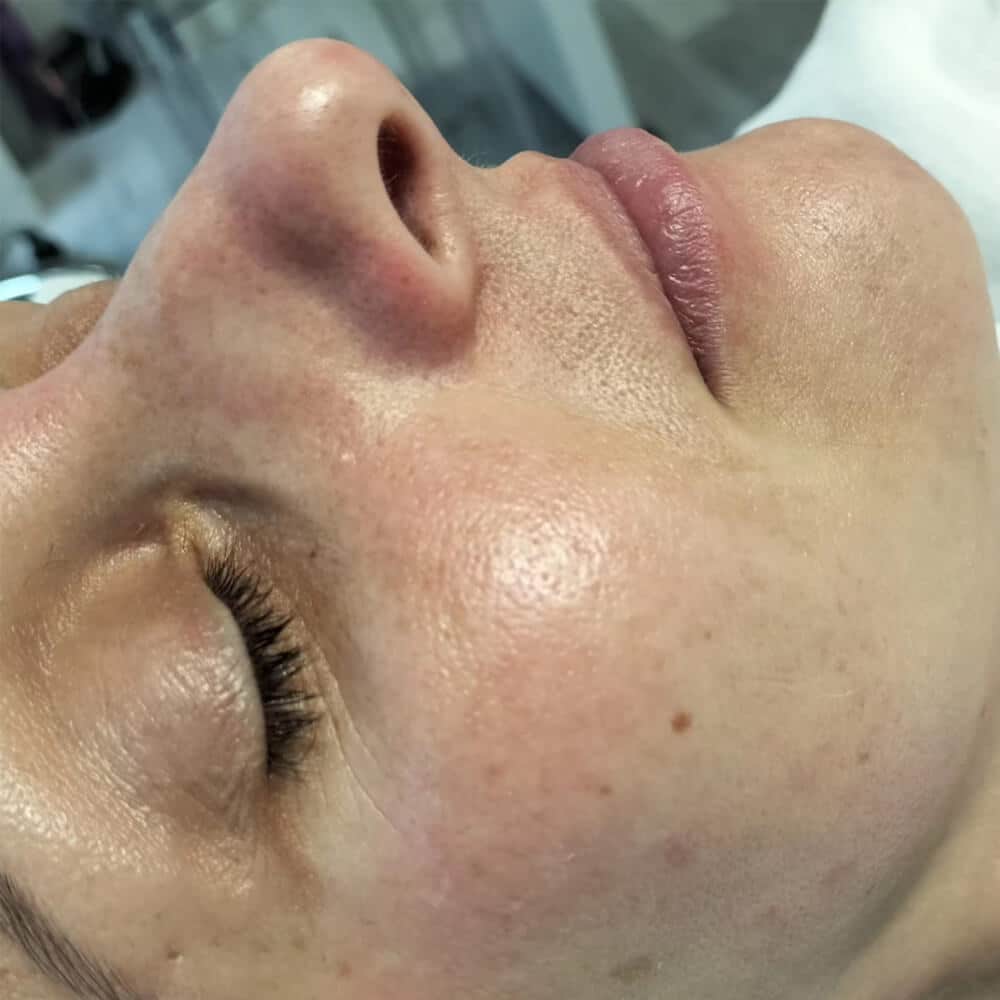 dermaplaning-maxinederaviarere-beauty-3
