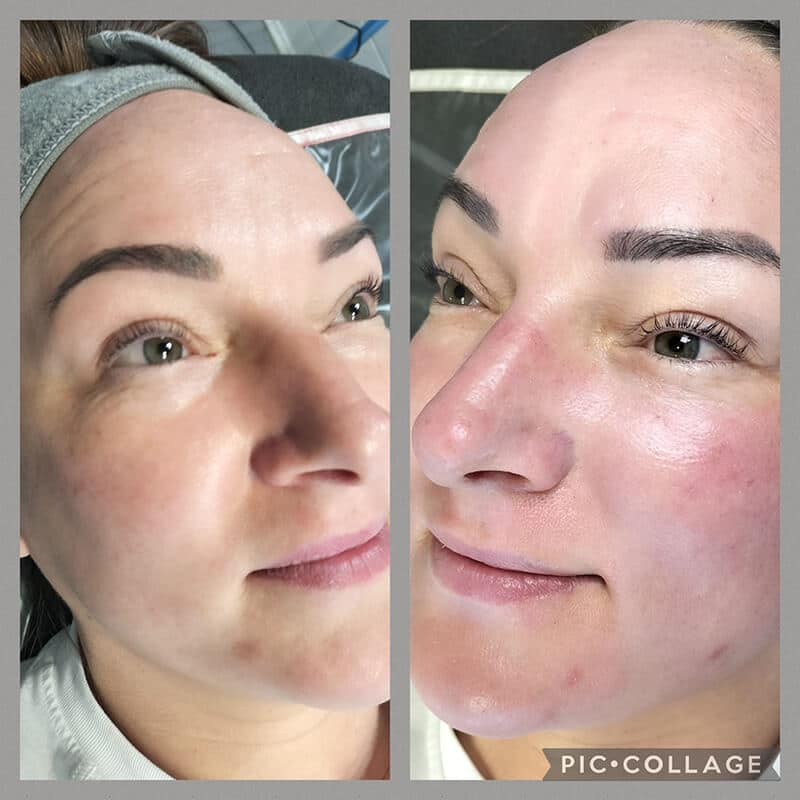 clinicare-midical-micro-needling-gallery-4